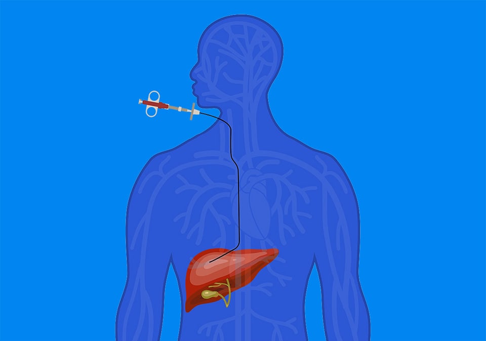 TheLiverDoc On X And So Transjugular Biopsy Was Done 45 OFF